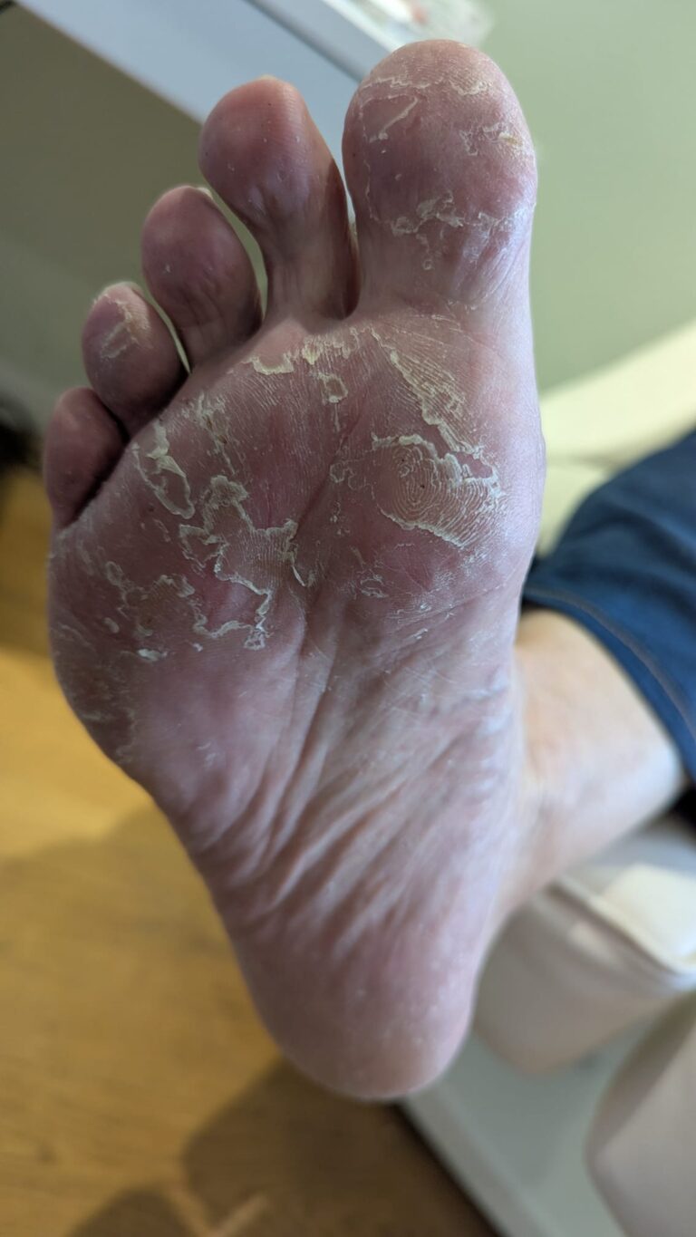 Fungal infection right foot